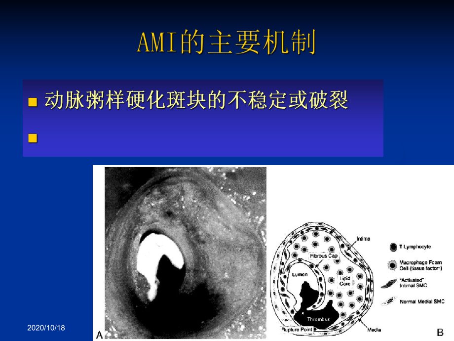 AMI的溶栓治疗优选课件.ppt_第2页