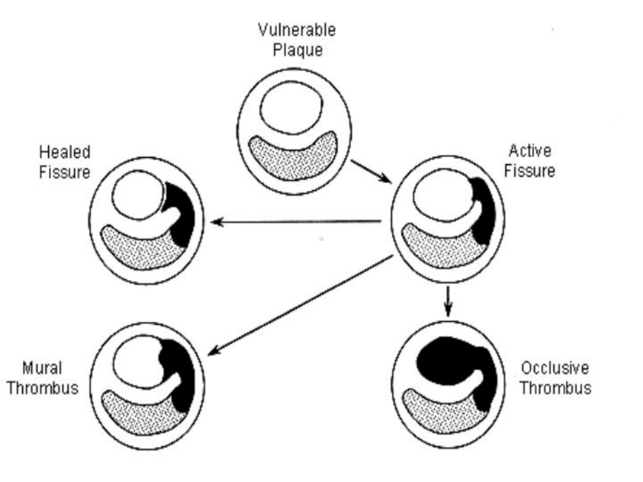 AMI的溶栓治疗优选课件.ppt_第3页