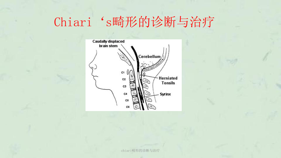 chiari畸形的诊断与治疗课件.ppt_第1页