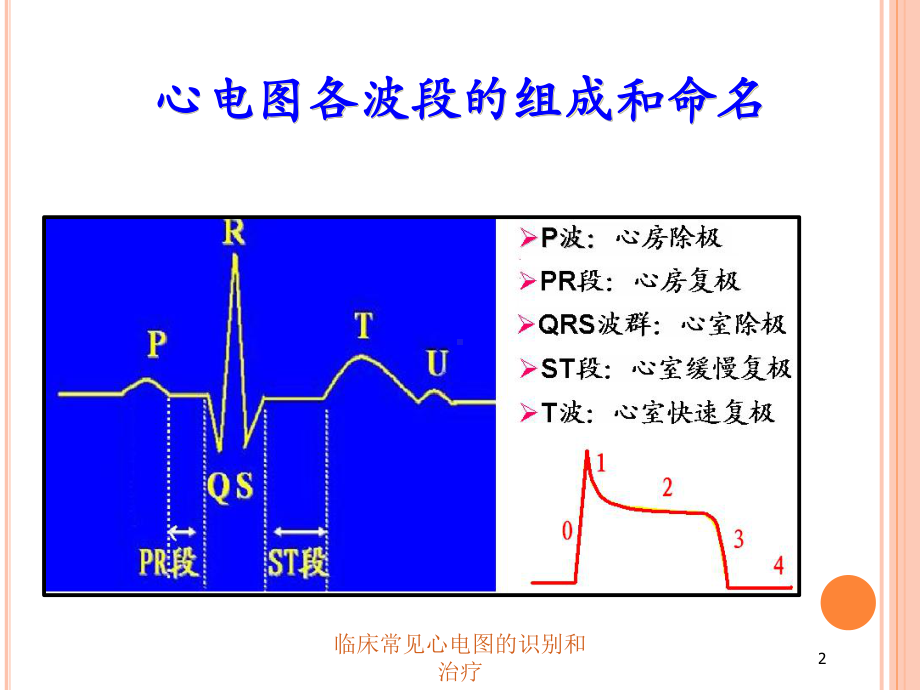 临床常见心电图的识别和治疗培训课件.ppt_第2页