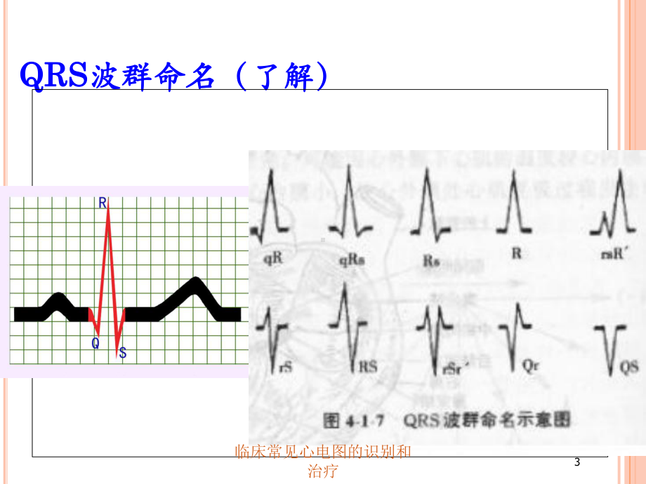 临床常见心电图的识别和治疗培训课件.ppt_第3页