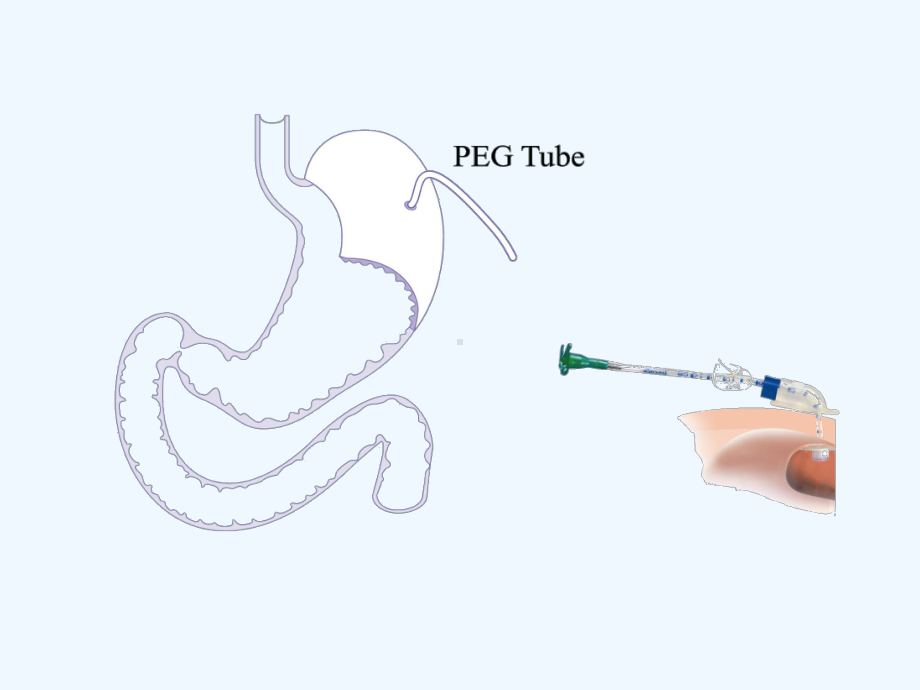 PEG经皮胃造瘘术的护理课件.ppt_第3页