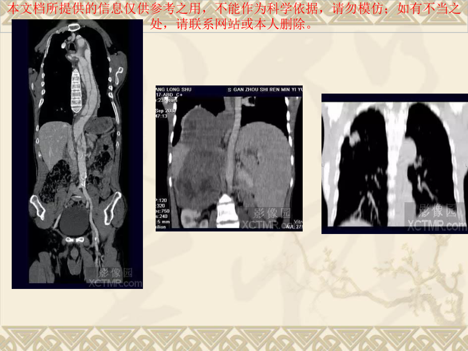 CT常用图像后处置培训课件.ppt_第2页