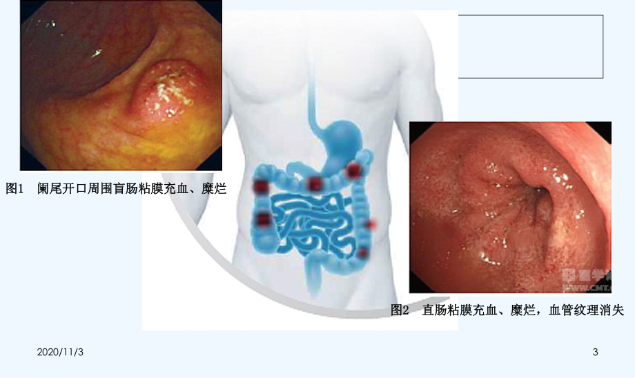 一波三折消化道出血课件.ppt_第3页