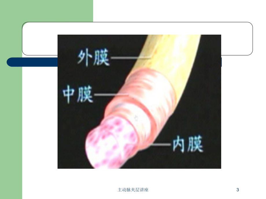 主动脉夹层讲座培训课件.ppt_第3页