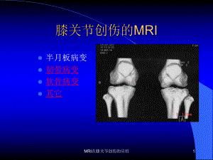 MRI在膝关节创伤的应用课件.ppt