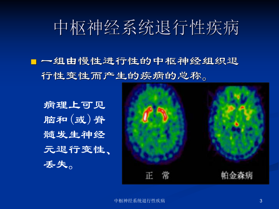 中枢神经系统退行性疾病课件.ppt_第3页