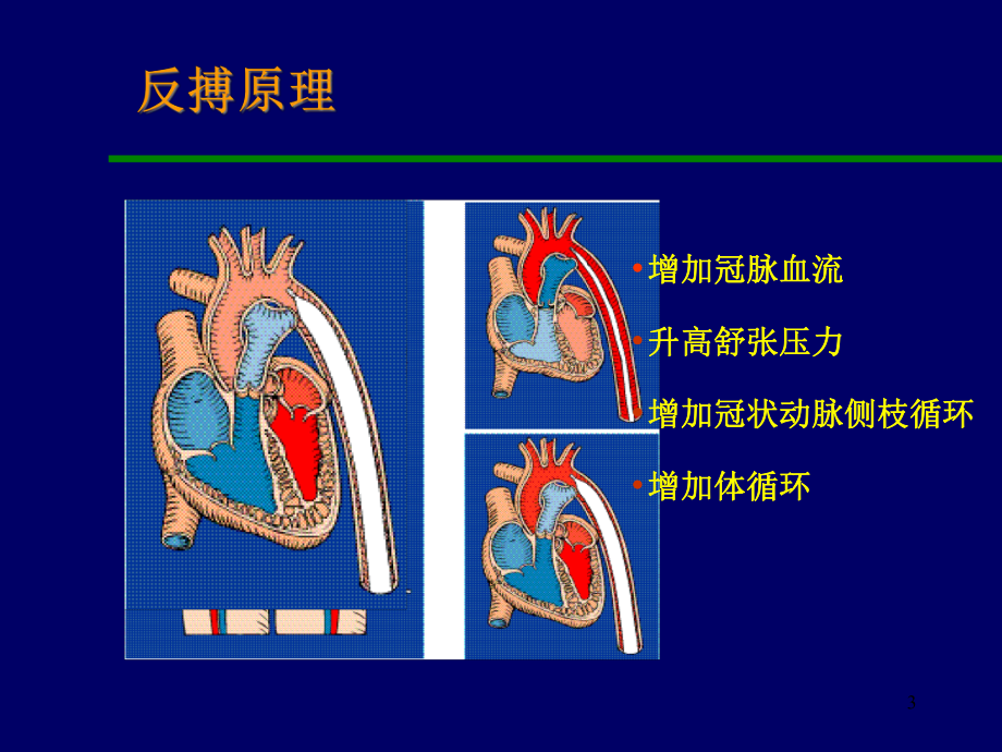 主动脉内球囊反搏泵演示文稿课件.ppt_第3页