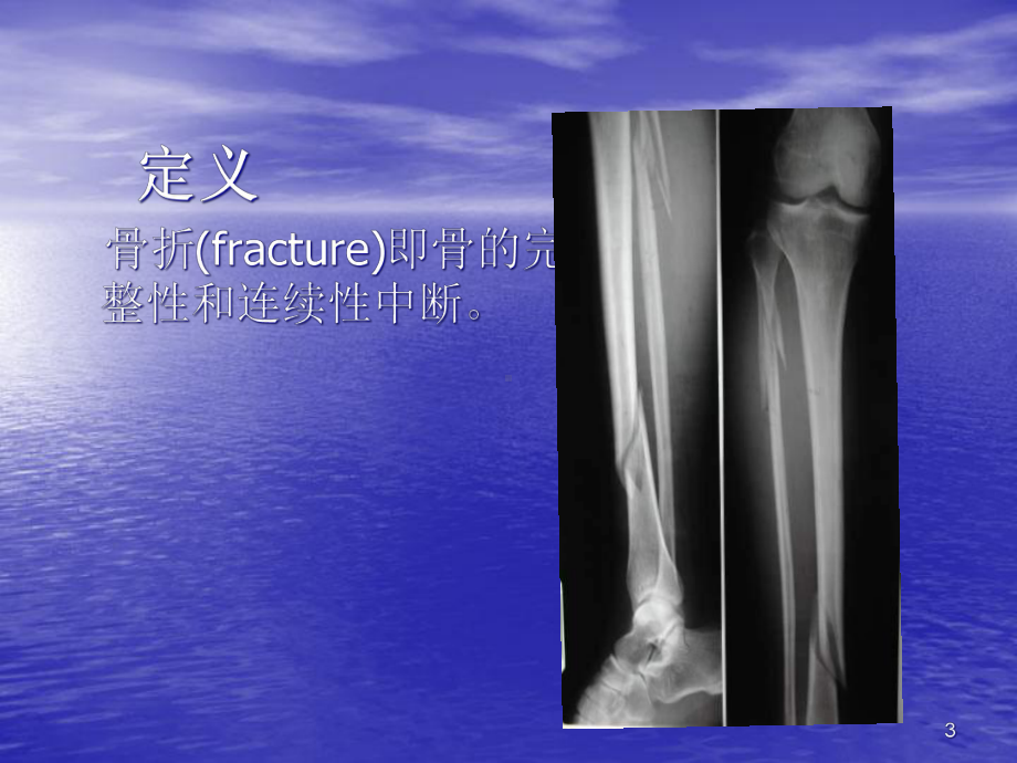 (医学)骨-折-概-论教学课件.ppt_第3页