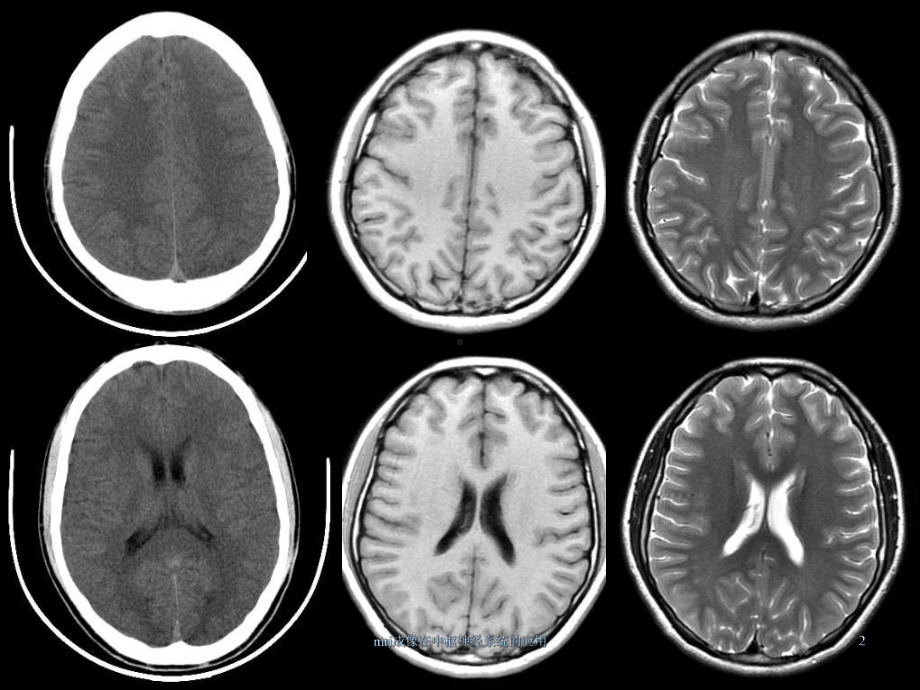 mri成像在中枢神经系统的应用课件.ppt_第2页