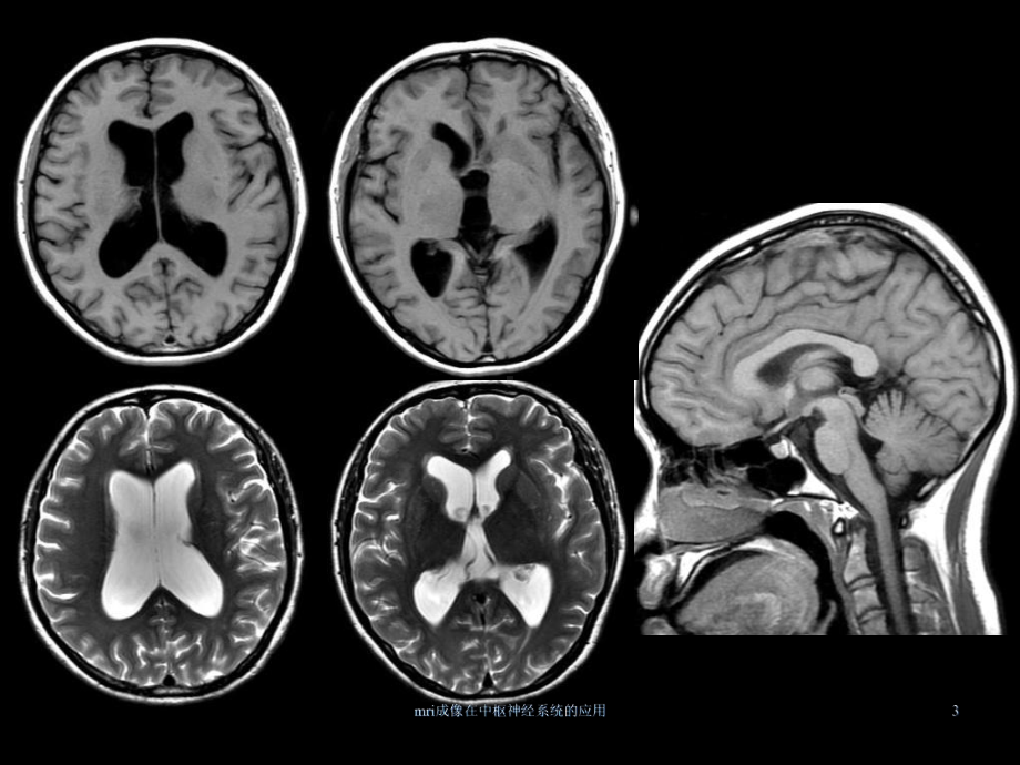 mri成像在中枢神经系统的应用课件.ppt_第3页