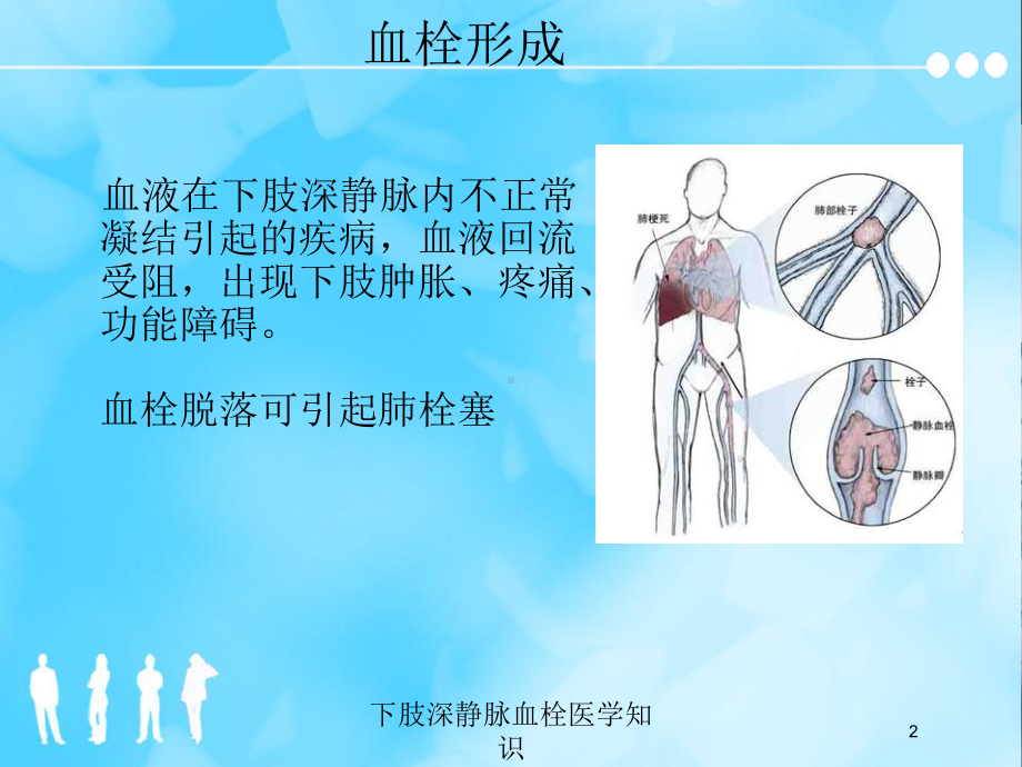 下肢深静脉血栓医学知识培训课件.ppt_第2页