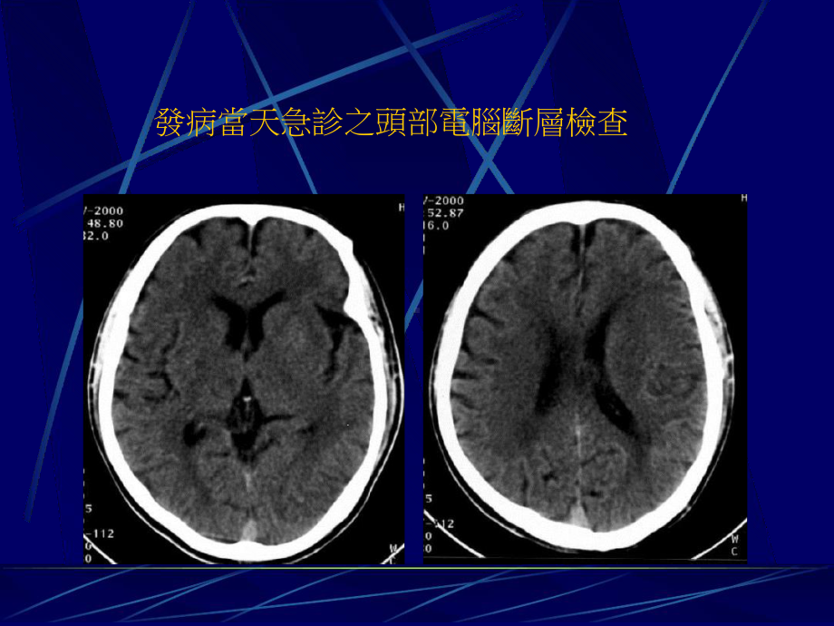 中大脑动脉阻塞课件.ppt_第3页