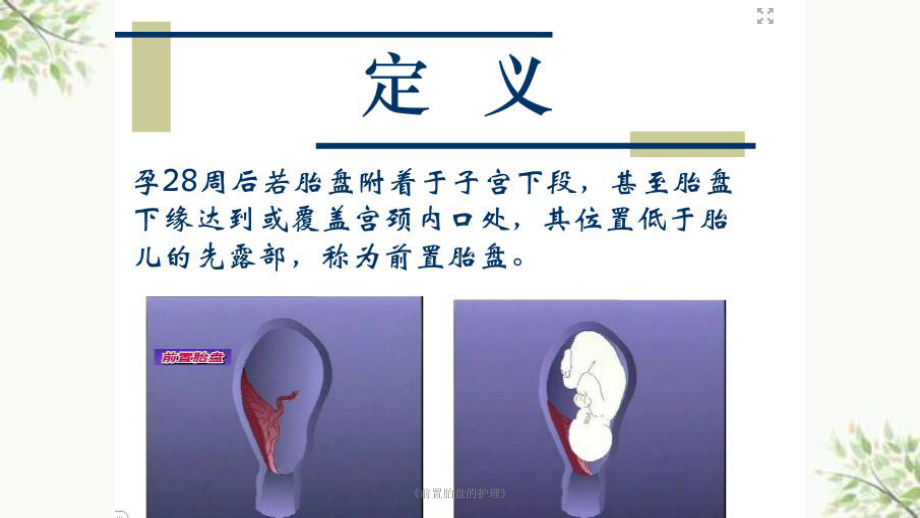 《前置胎盘的护理》课件.ppt_第3页