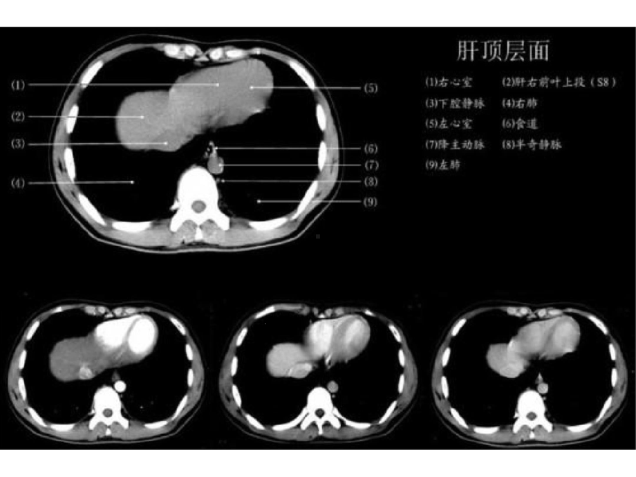 上腹部CT各个层面课件.ppt_第2页