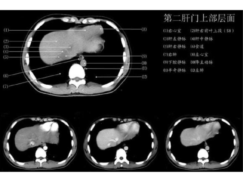 上腹部CT各个层面课件.ppt_第3页