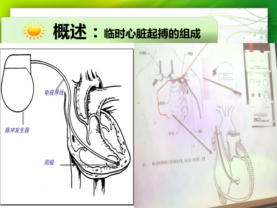 临时起搏治疗及护理动画演示医护同享课件.pptx_第3页