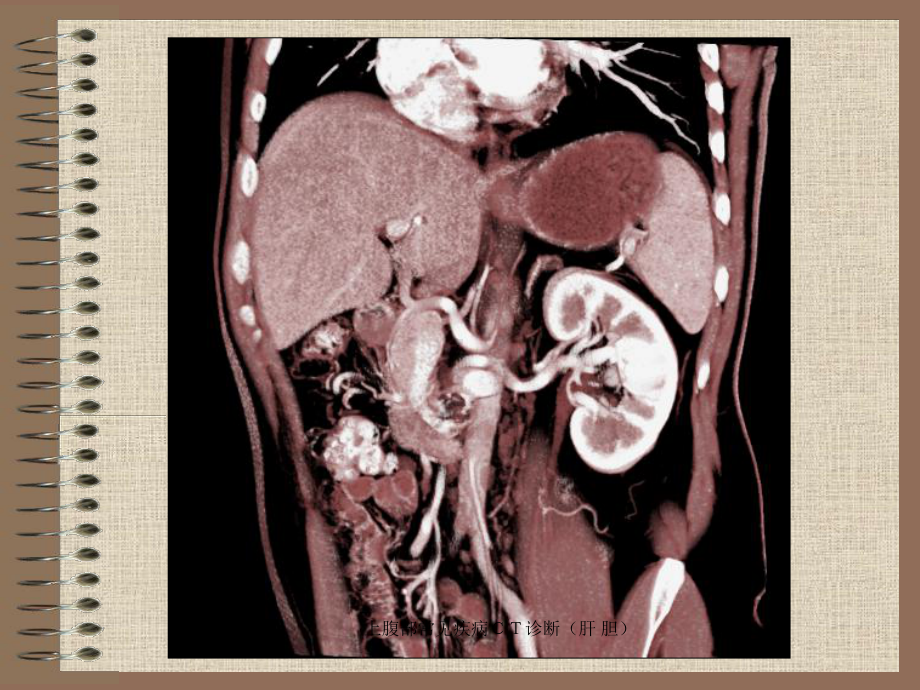 上腹部常见疾病CT诊断(肝-胆)课件.ppt_第2页