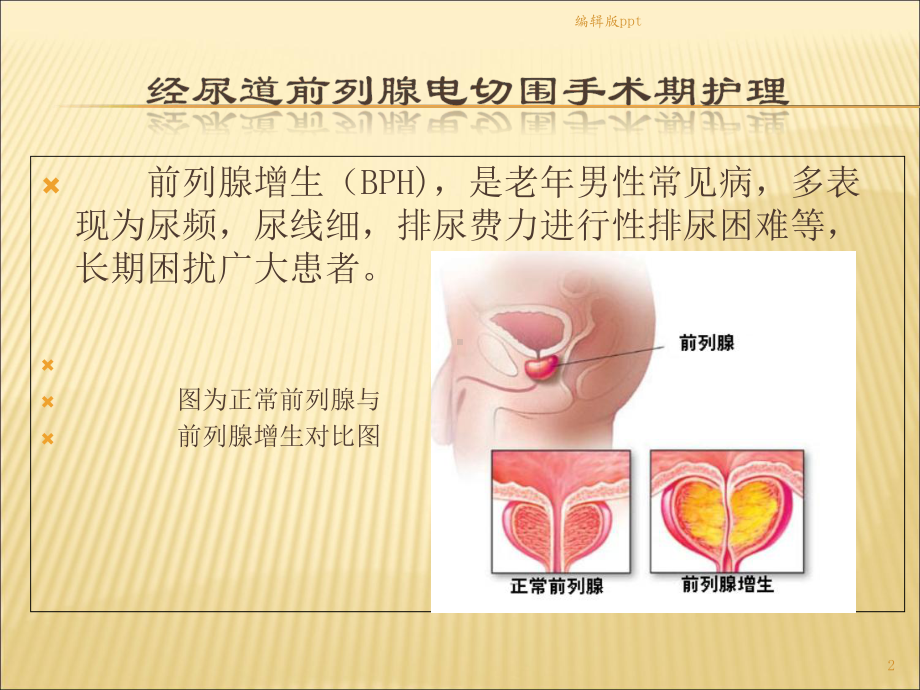 前列腺电切围手术期护理课件.ppt_第2页