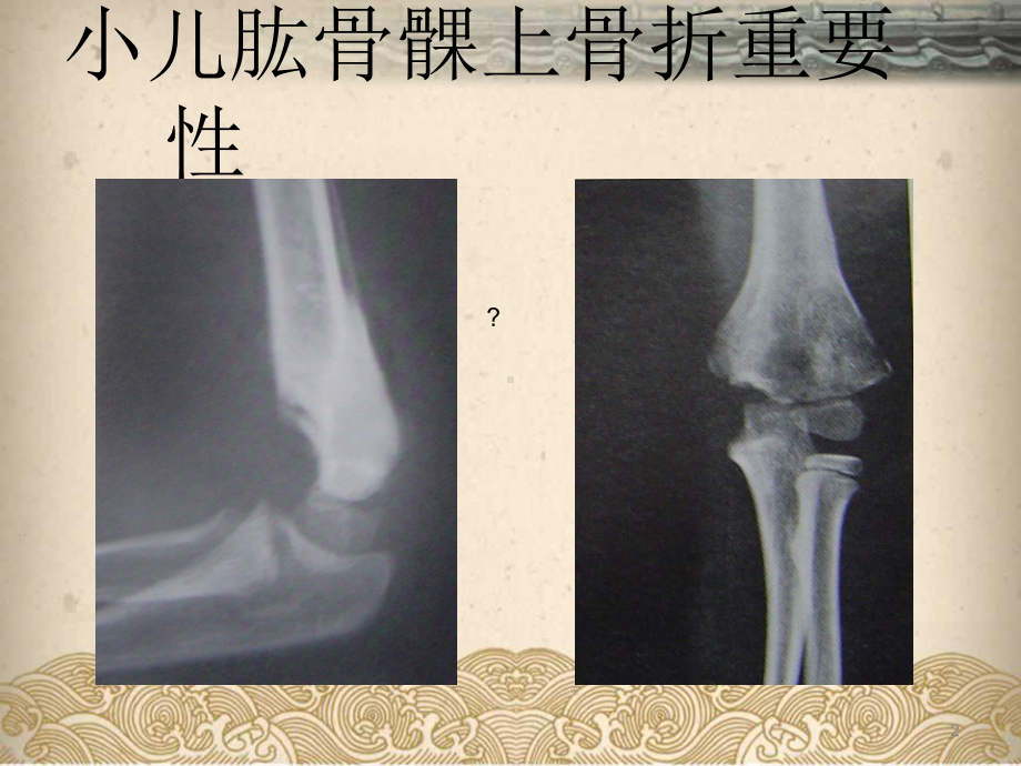 小儿肱骨髁上骨折参考课件.ppt_第2页