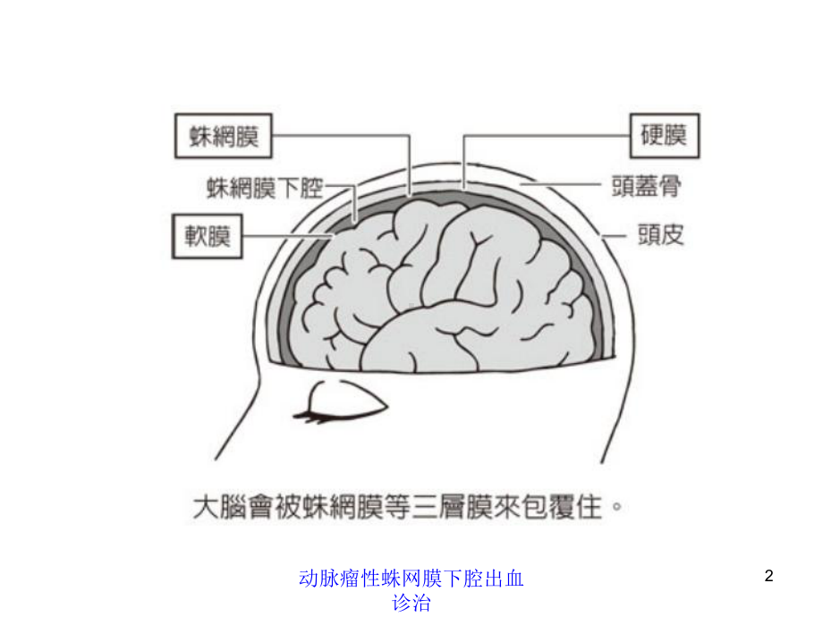 动脉瘤性蛛网膜下腔出血诊治培训课件.ppt_第2页