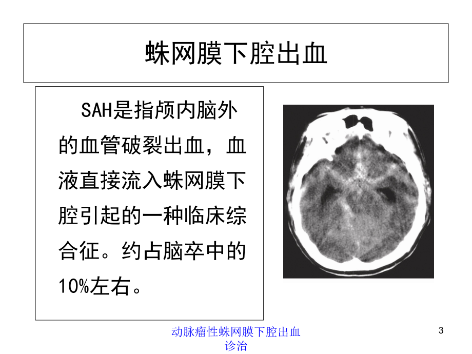 动脉瘤性蛛网膜下腔出血诊治培训课件.ppt_第3页