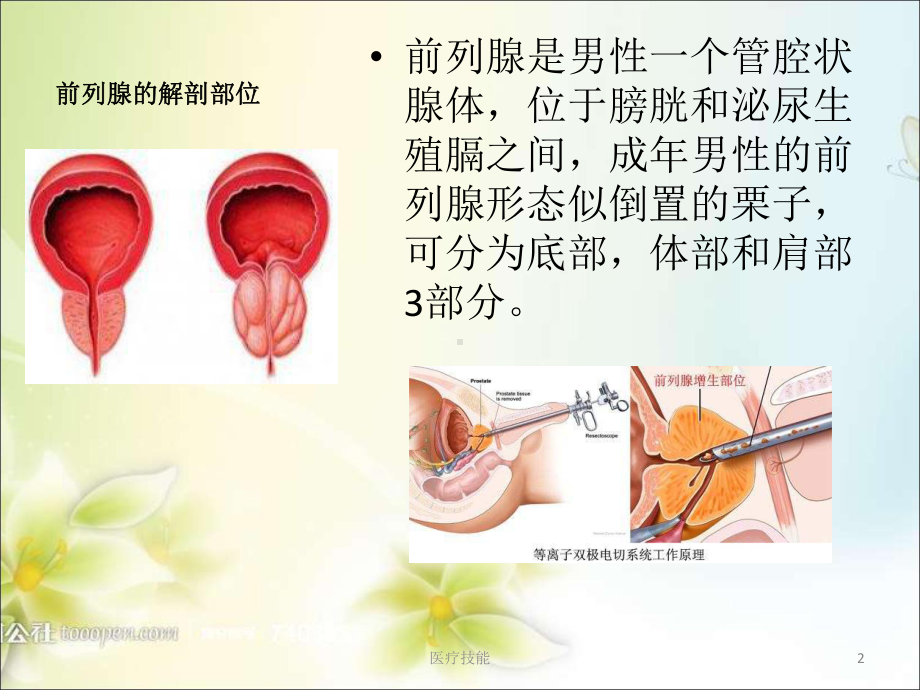 前列腺电切术(TURP)(医学技术)课件.ppt_第2页