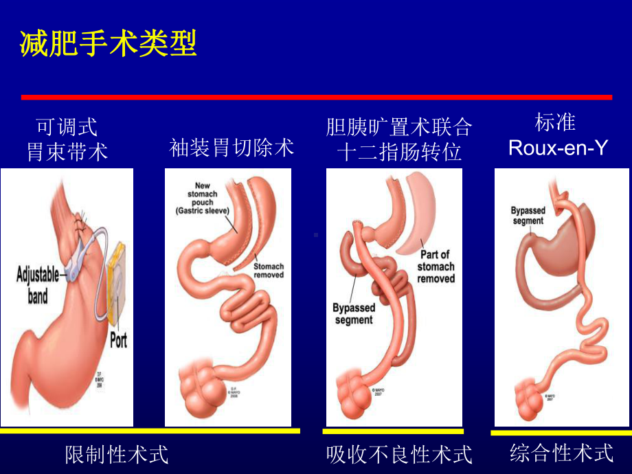 减肥手术后内分泌代谢紊乱及预防课件.ppt_第2页