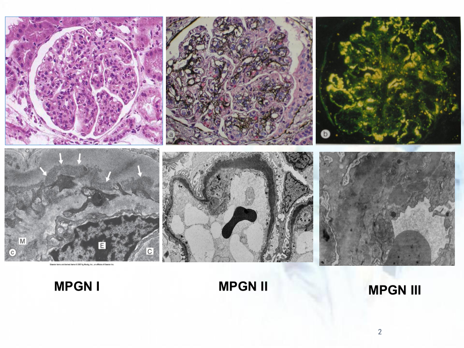 医学课件-C3肾小球病新概念课件.ppt_第2页