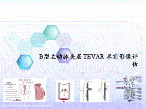 医学课件-B型主动脉夹层术前影像学评估教学课件.pptx