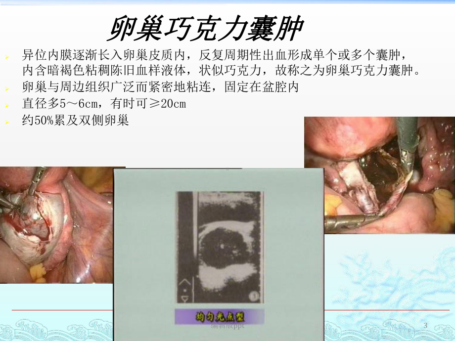 子宫内膜异位症和腺肌症课件.ppt_第3页