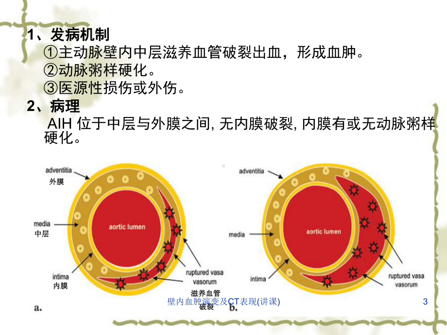 壁内血肿演变及CT表现(讲课)课件.ppt_第3页