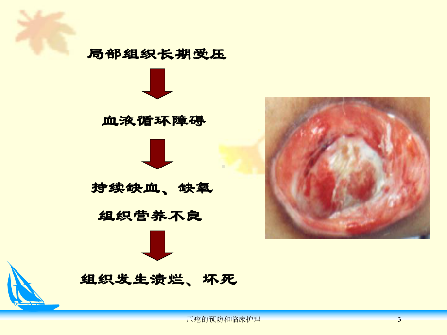 压疮的预防和临床护理培训课件.ppt_第3页