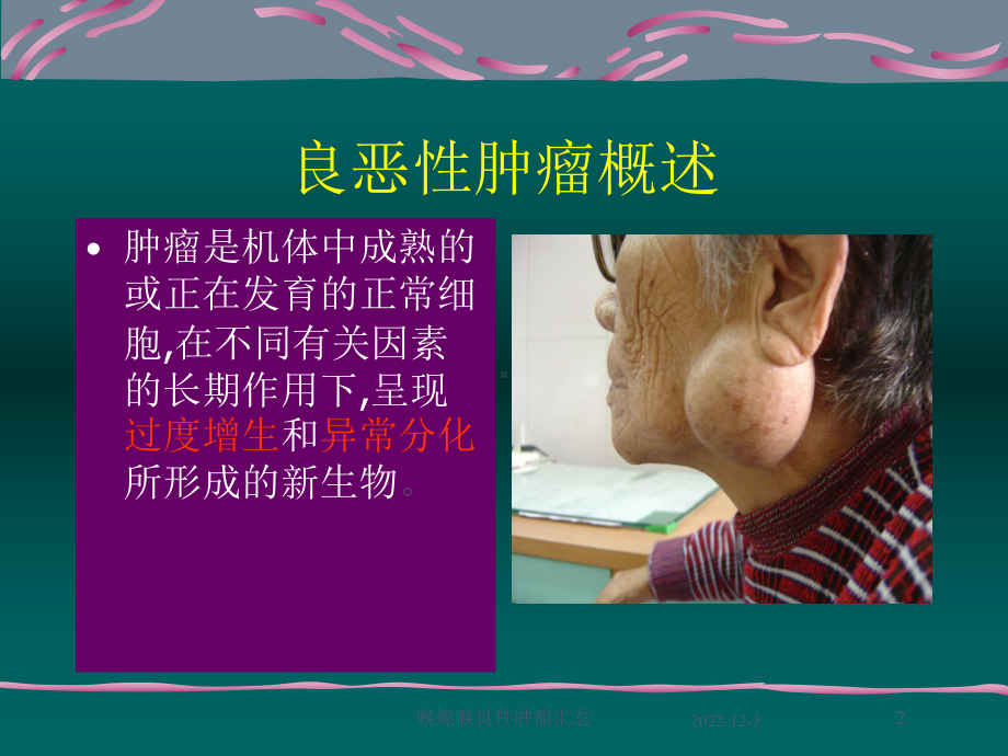 喉癌喉良性肿瘤汇总课件.ppt_第2页