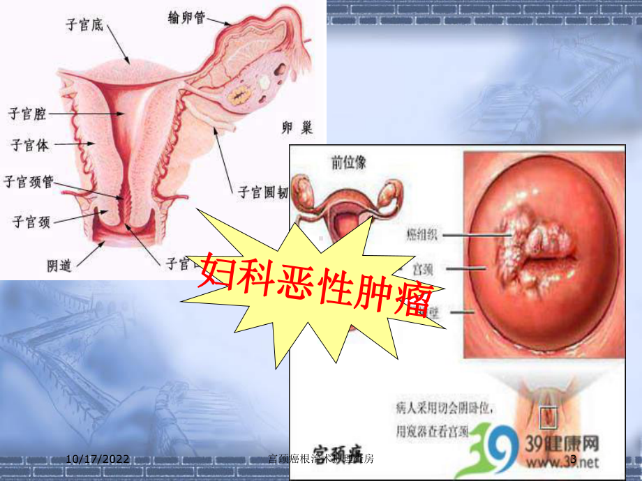 宫颈癌根治术护理查房培训课件.ppt_第3页