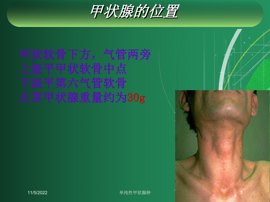 单纯性甲状腺肿培训课件.ppt_第3页