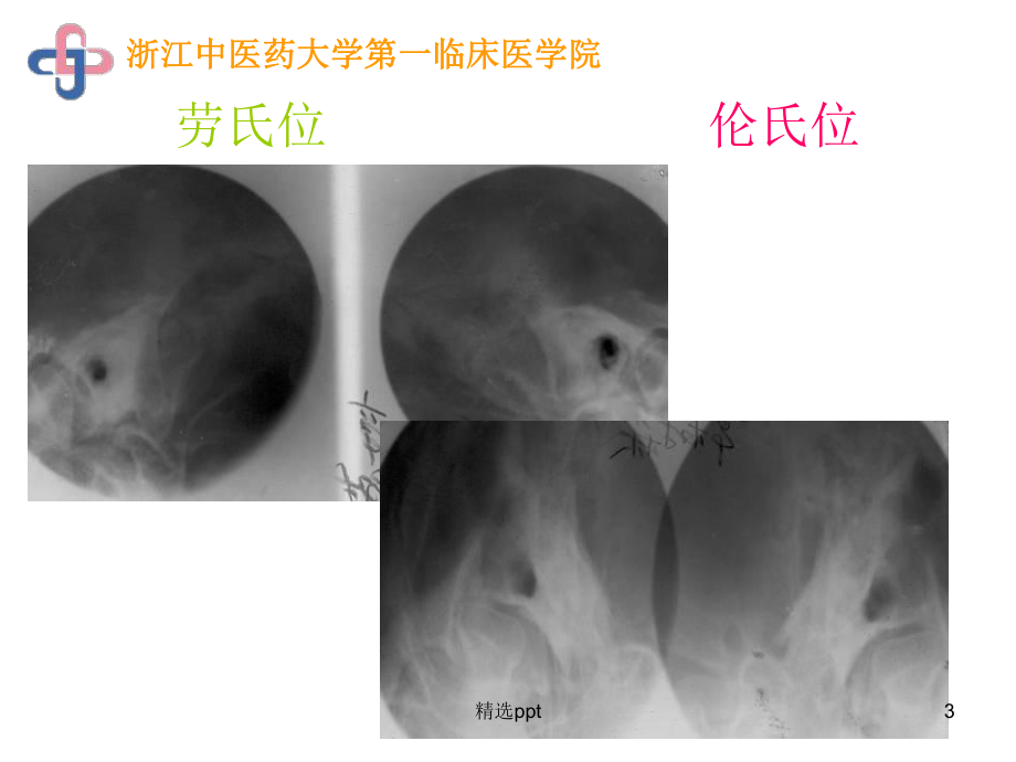 乳突影像学诊断课件.ppt_第3页