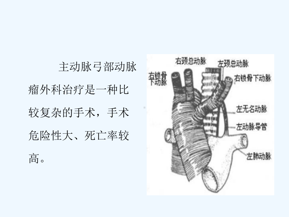 主动脉置换术解读课件.ppt_第2页