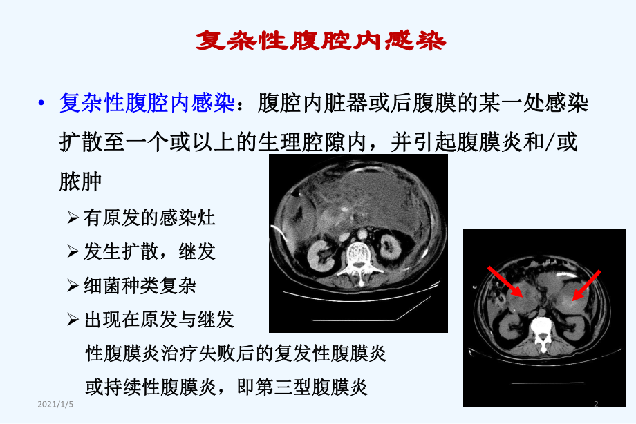 复杂性腹腔感染的处理毛恩强课件.ppt_第2页