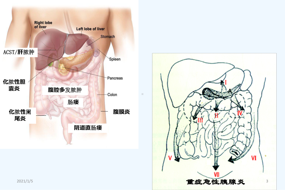 复杂性腹腔感染的处理毛恩强课件.ppt_第3页