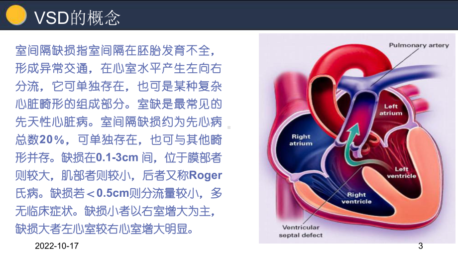 室间隔缺损护理查房参考课件.ppt_第3页