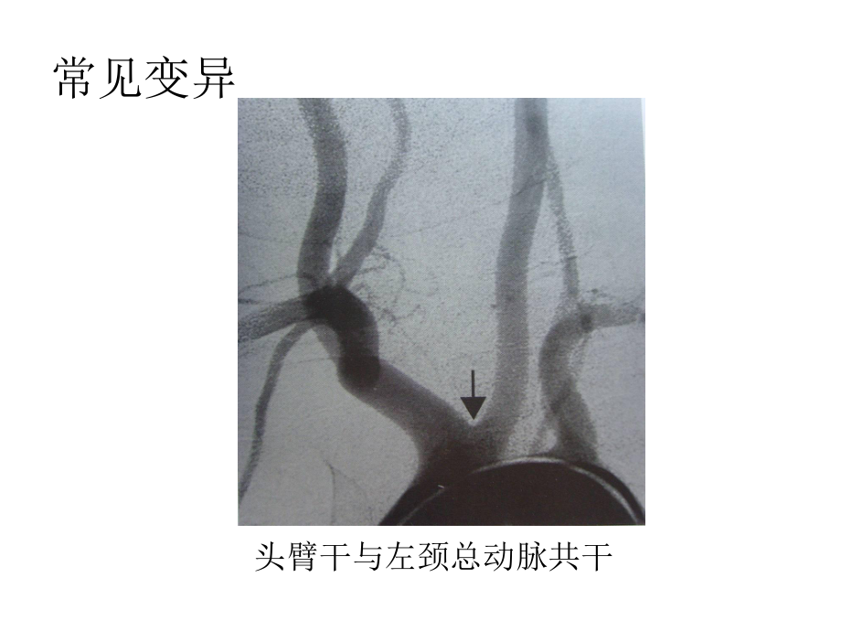 医学课件脑血管的正常变异和异常.ppt_第3页