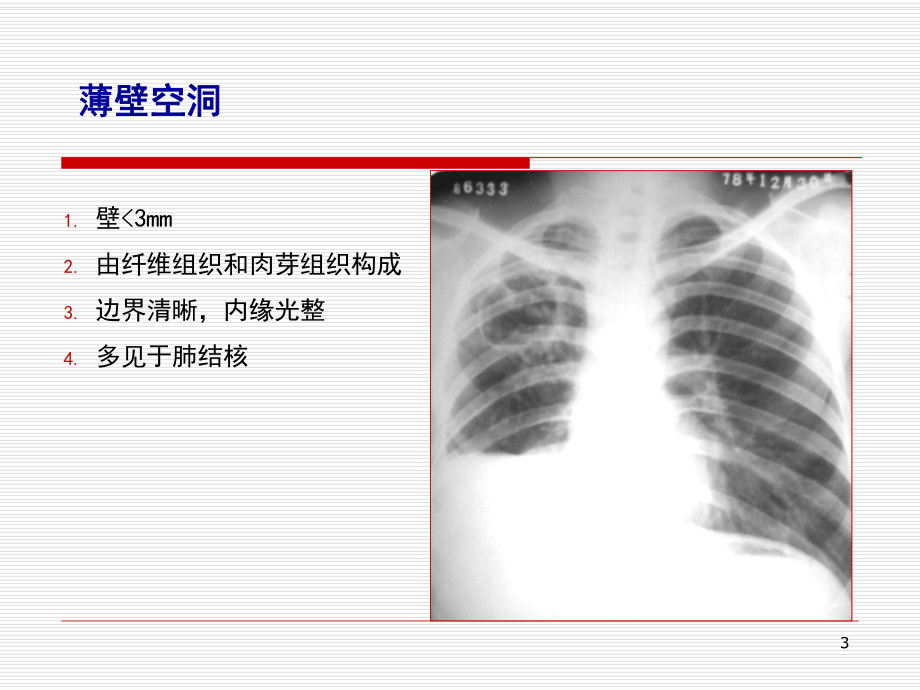 医学课件-呼吸基本病变课件.ppt_第3页