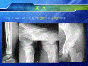 四肢骨折的诊疗和治疗课件.ppt