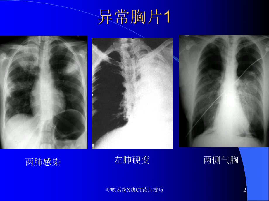 呼吸系统X线CT读片技巧课件.ppt_第2页