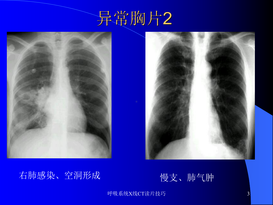 呼吸系统X线CT读片技巧课件.ppt_第3页