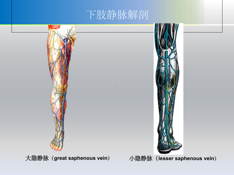 大隐静脉曲张剥脱术课件.ppt_第2页