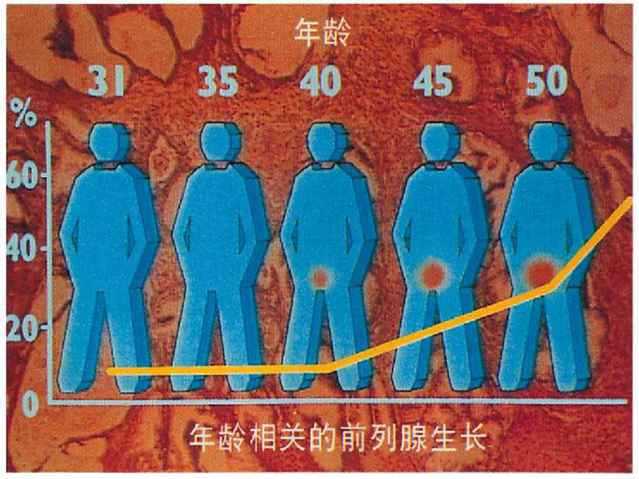 前列腺增生医疗护理专题宣讲课件.ppt_第2页