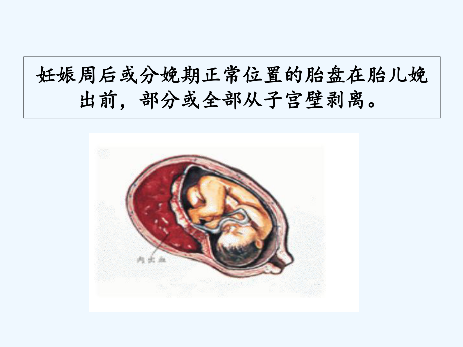 妇产科学-胎盘早剥前置胎盘课件.ppt_第3页