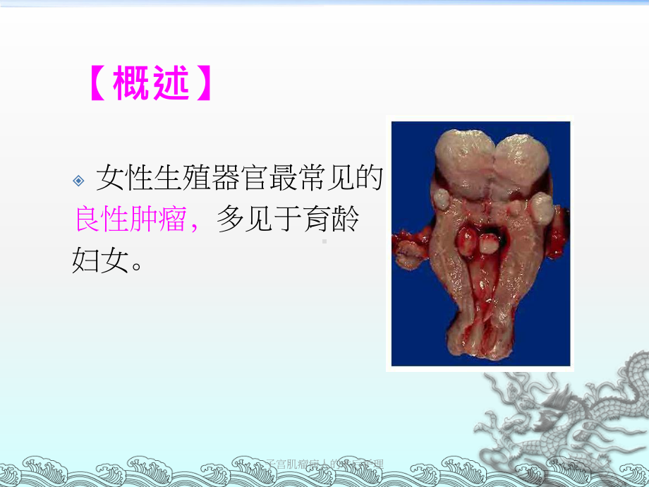 子宫肌瘤病人的术后护理培训课件.ppt_第3页